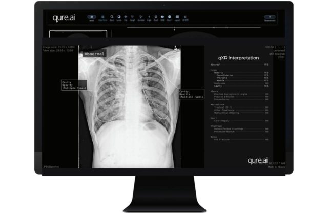 Unilabs podpísal dohodu s Qure.ai o vyhodnocovaní a triedení röntgenových snímok hrudníka