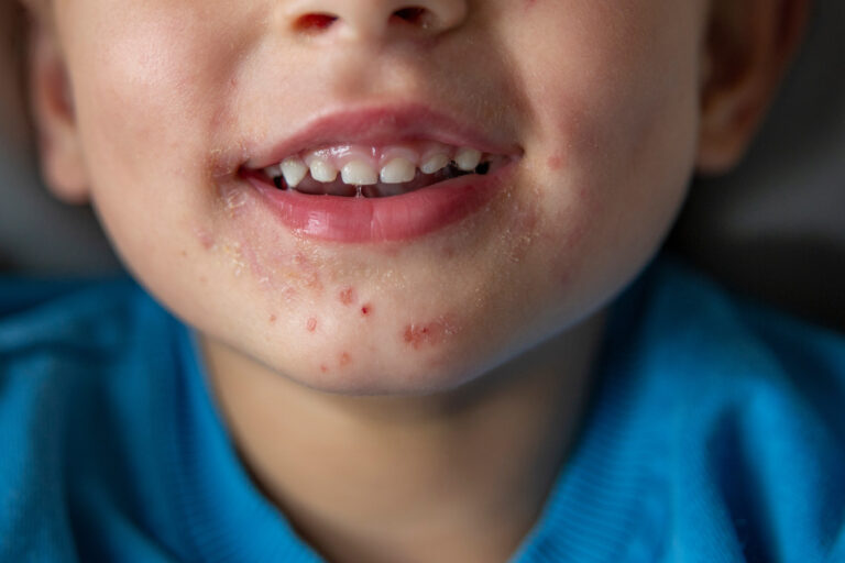 Siedma choroba (syndróm ruka, noha a ústa) – číha aj na vaše deti?